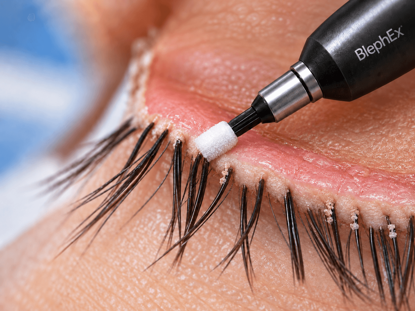 Close-up of BlephEx treatment cleaning biofilm from the eyelid margin at the lash roots