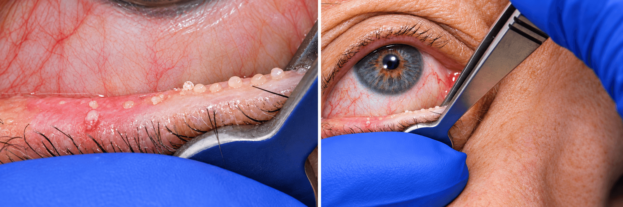 Meibomian gland expression (MGX) bringing secretion out along the eyelid margin