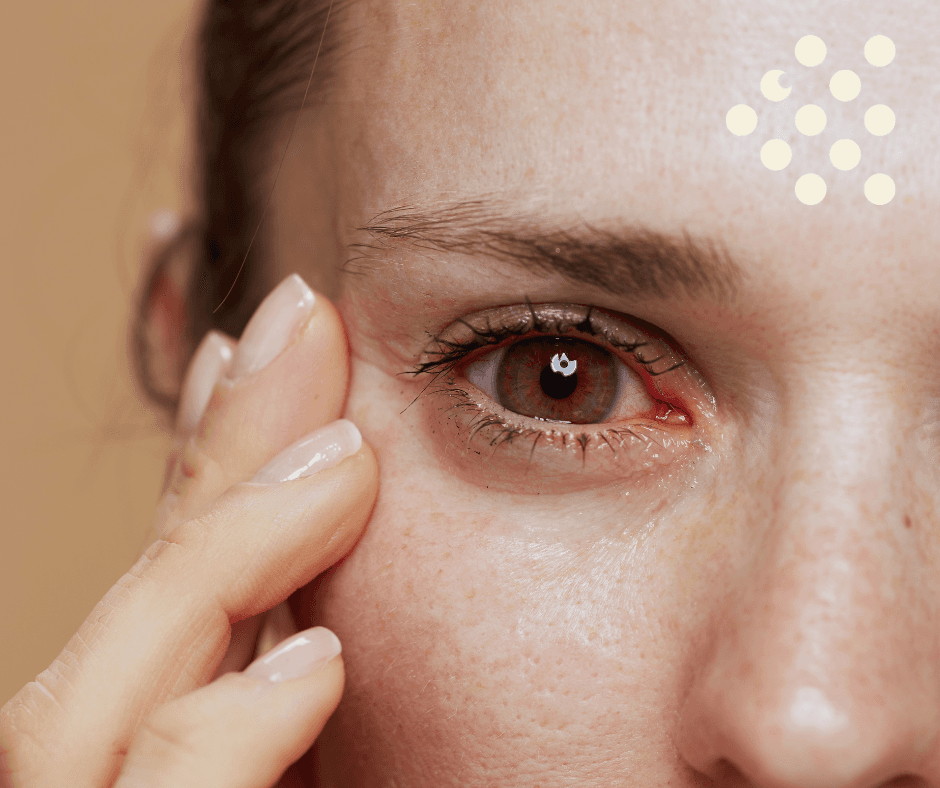 Symptoms of dry eye – stinging, grittiness and redness